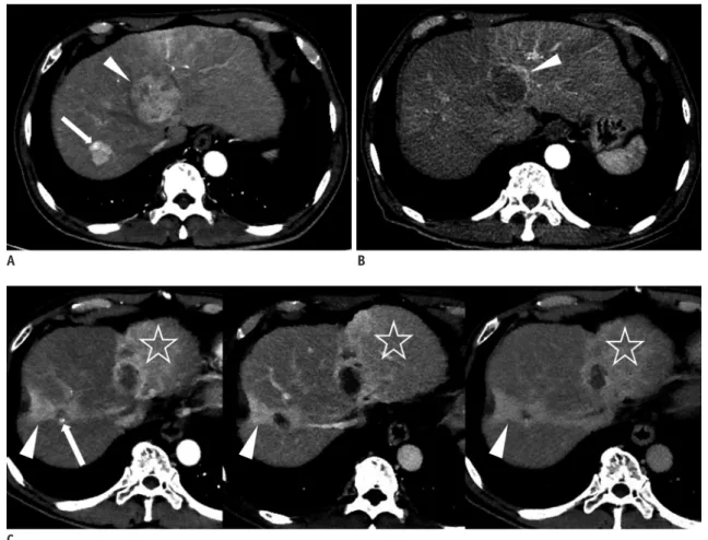 Fig. 8. 67-year-old man with HCC. 