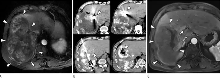 Fig. 3. 58-year-old man with HCC who underwent CT-guided MWA after TACE.
