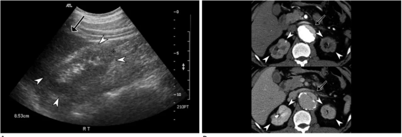 Fig. 2. Glomerulonephritis in 37-year-old male with long history of hypertension and nephrotic range proteinuria