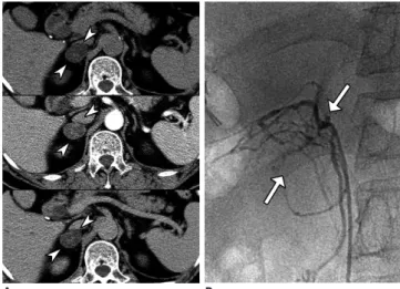 Fig. 8. Primary aldosteronism in 68-year-old male with  uncontrolled hypertension, low level of plasma renin activity  (0.2 ng/mL/hr) and elevated aldosterone level (47 ng/dL)