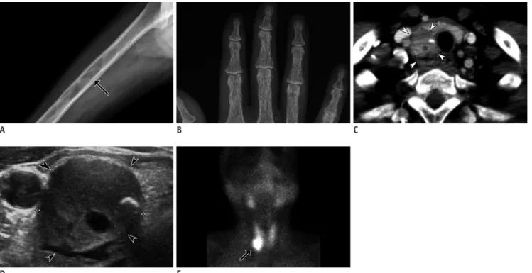 Fig. 12. Hyperparathyroidism in 47-year-old female with hypertension and generalized weakness