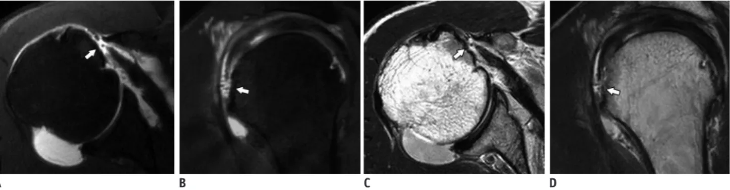 Fig. 2. 64-year-old man with full-thickness SSC tendon tear diagnosed by arthroscopy. 
