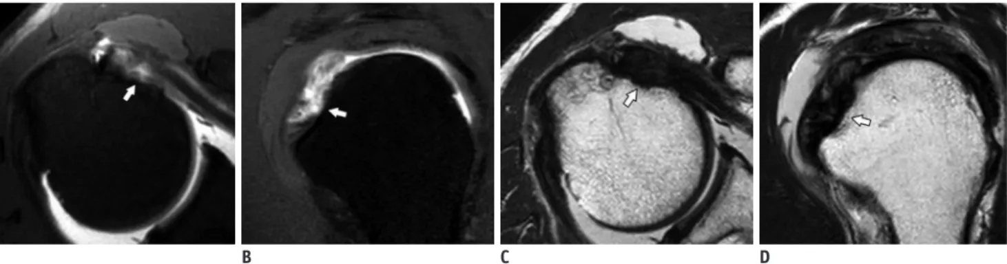 Fig. 4. 68-year-old man with articular-sided partial-thickness SSC tendon tear confirmed by arthroscopy