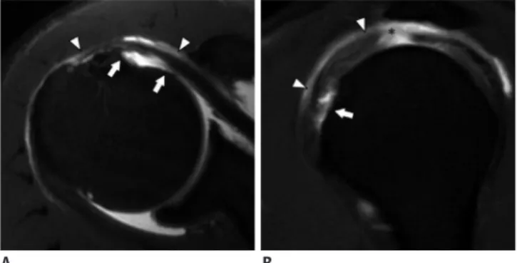 Fig. 5. 68-year-old man with arthroscopically diagnosed full- full-thickness SSC tendon tear