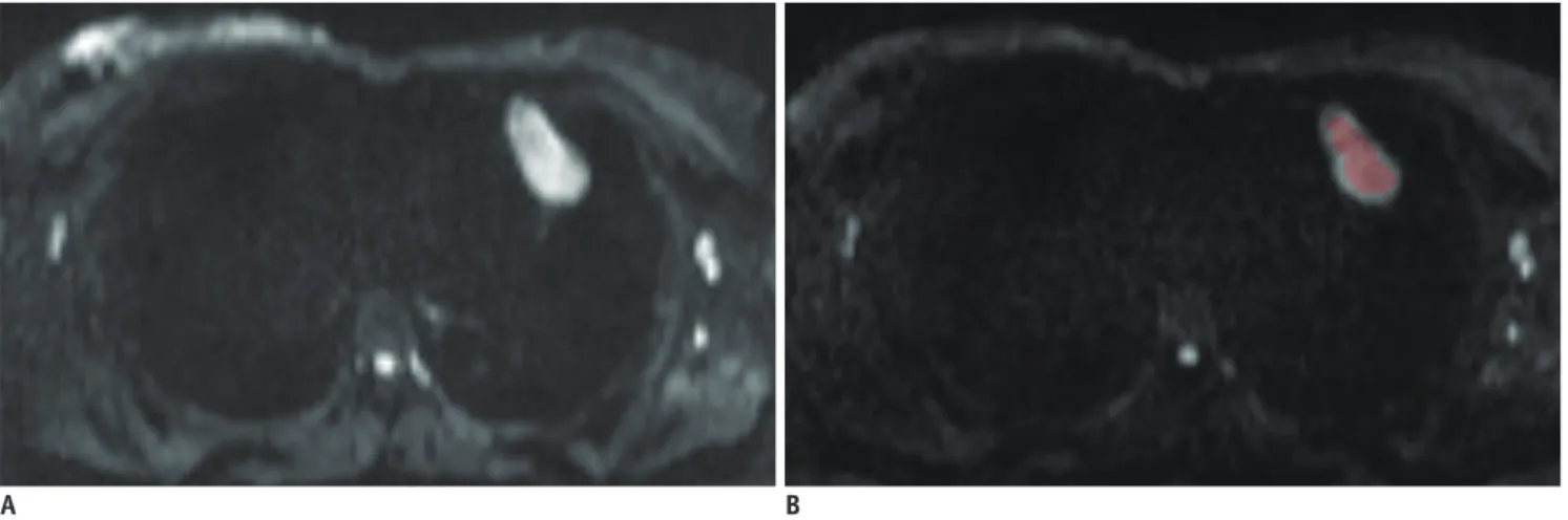 Table 2 summarizes the detailed comparisons of the  histogram-based and hot-spot-ROI-based ADC measurements  between the thymic carcinoma and lymphoma groups