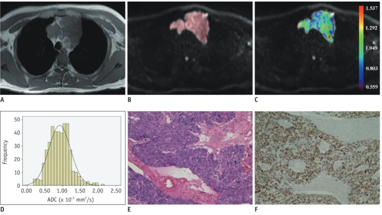 Fig. 4. Images of 42-year-old man with thymic squamous cell carcinoma. 