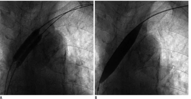 Fig. 1. Angioplasty technique.