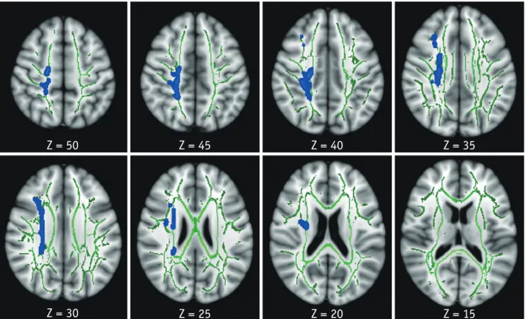 Fig. 1. TBSS analysis of FA maps.  Areas in sky blue-blue represent brain regions with significant decrease in FA (FWE-corrected p < 0.05)  in HAND group relative to HC