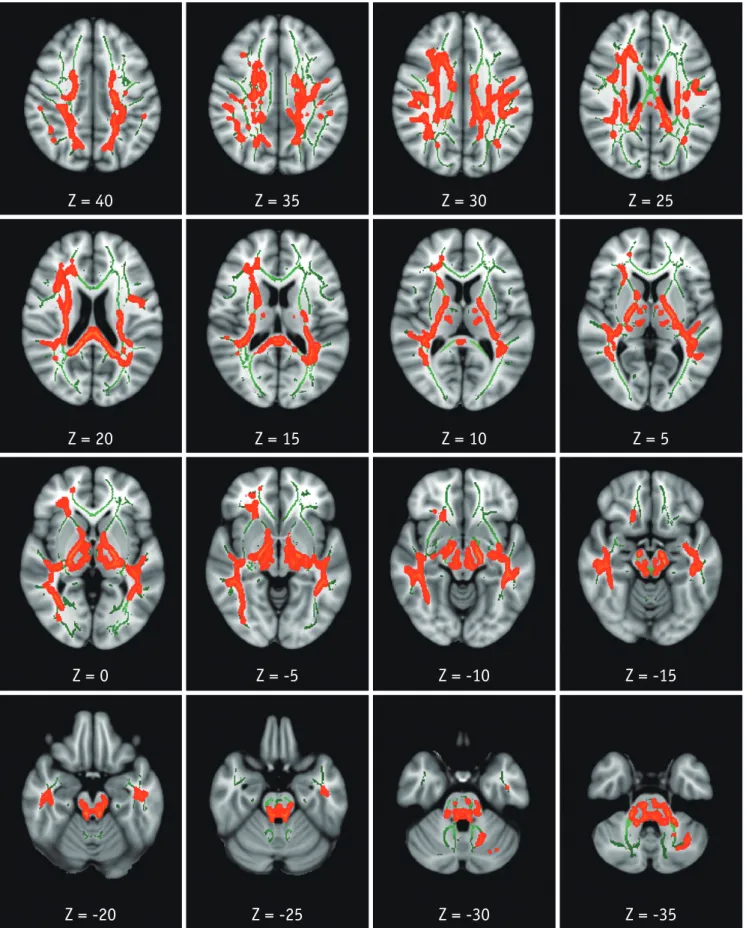 Fig. 2. TBSS analysis of MD maps.  Areas in orange-red represent brain regions with significant increase in MD (FWE-corrected p < 0.05) in  HAND group relative to HC