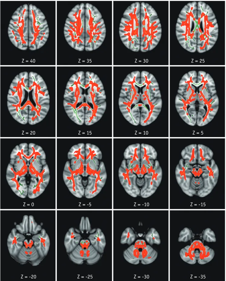 Fig. 3. TBSS analysis of RD maps.  Areas in orange-red represent brain regions with significant increase in RD (FWE-corrected p < 0.05) in  HAND group relative to HC