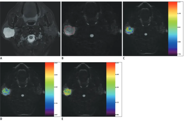 Fig. 3. 53-year-old man with pleomorphic adenoma of parotid gland. 