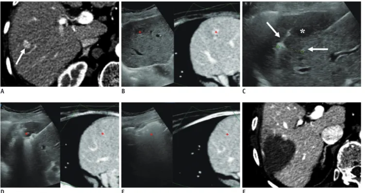 Fig. 3. RFA for HCC using multiple electrodes with “no-touch” technique under fusion imaging guidance.