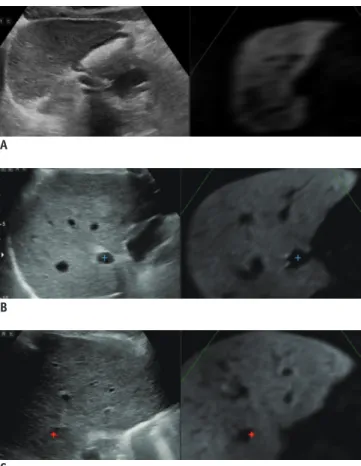 Fig. 4. Process of fusion imaging between real-time US and  reference MR images.