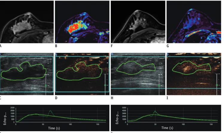 Table 3 shows the diagnostic performance of post-NAC  DCE-MRI histogram metrics to predict good response after  NAC