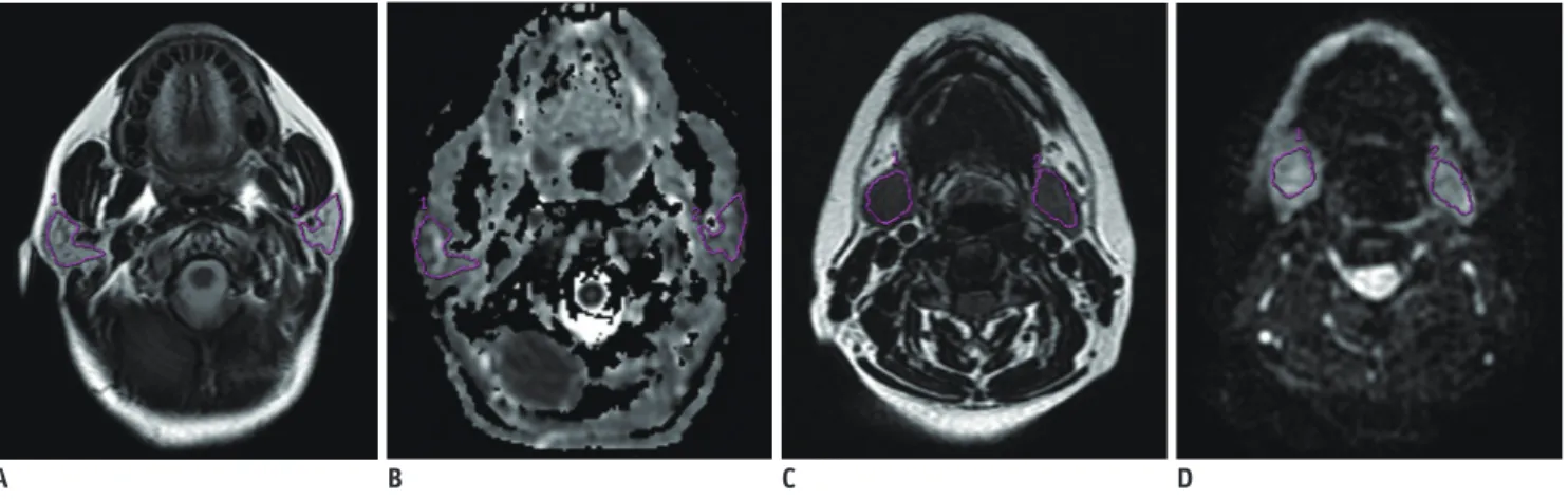 Fig. 1. 55-year-old male patient with nasopharyngeal carcinoma before RT. 