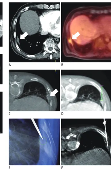 Fig. 2. 81-year-old man with colon cancer and hepatic  metastasis: true negative case of CBCT virtual  navigation-guided percutaneous pleural lesion biopsy