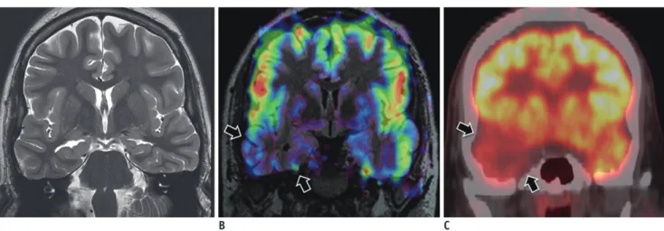 Fig. 11. sMRI negative temporal epilepsy.  15-year-old boy with temporal neocortical epilepsy