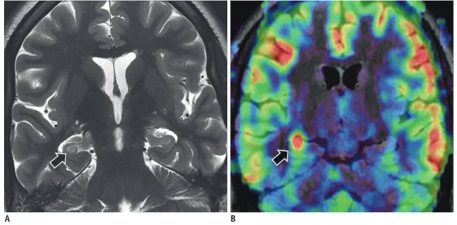 Fig. 2. Hippocampal sclerosis. 