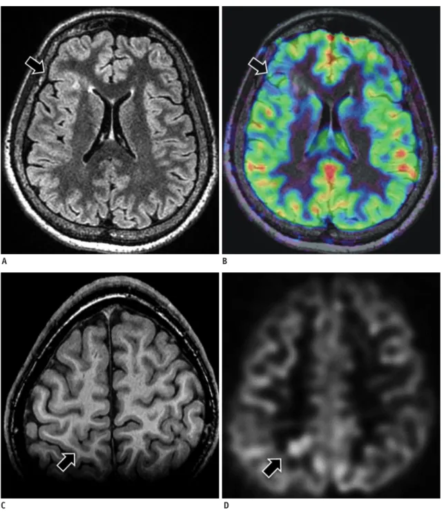 Fig. 3. Focal cortical dysplasia.