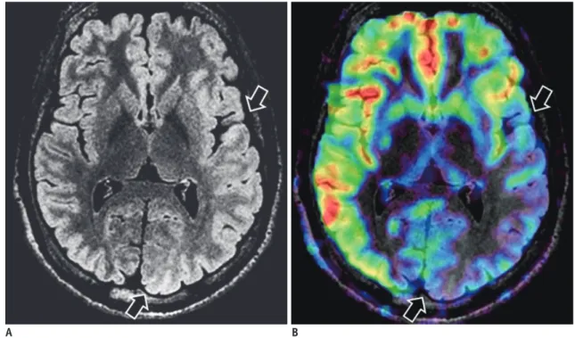 Fig. 5. Polymicrogyria. 