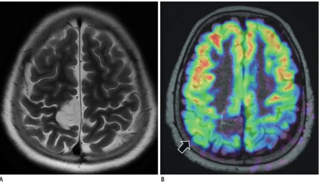 Fig. 6. Dysembryoplastic neuroepithelial tumor. 