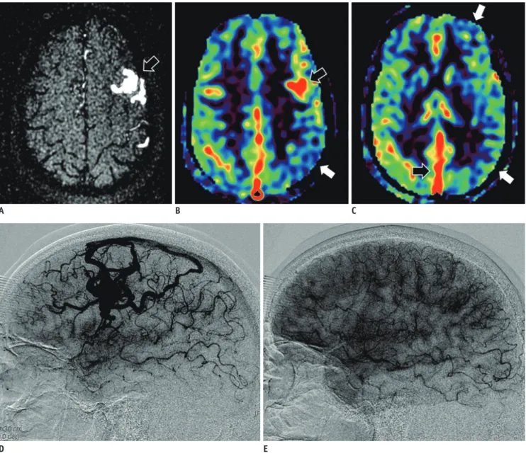 Fig. 7. Arteriovenous malformation. 