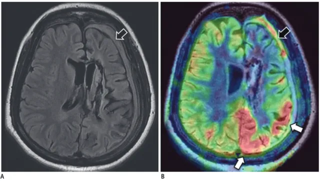 Fig. 8. Rasmussen’s syndrome. 