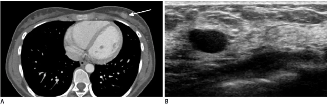 Fig. 3. Findings in 1-day-old boy who had palpable mass in right lateral portion of chest wall.