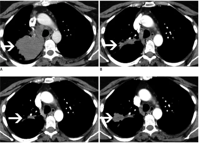 Fig. 3. Axial contrast enhanced CT on soft tissue windows at four different time points in 57-year-old woman with EGFR exon 19  deletion lung adenocarcinoma