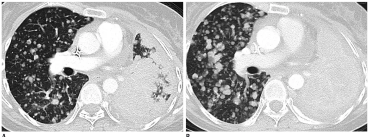 Fig. 4. Axial CECT on lung windows in 53-year-old woman with L8585R point mutation in exon 21 adenocarcinoma