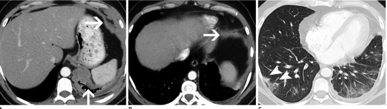 Fig. 7. Axial contrast enhanced CT on soft tissue (A, B) and lung windows (C) in 38-year-old man lifelong non smoker with  metastatic ALK rearranged lung adenocarcinoma