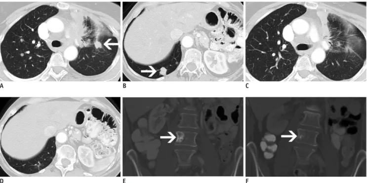 Fig. 8. Axial (A–D) and coronal enhanced (E, F) CT in 58-year-old woman with metastatic lung adenocarcinoma with ALK  rearrangement