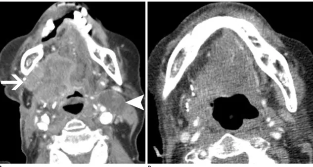 Fig. 9. Axial CECT at floor of mouth in 58-year-old man with EGFR mutant squamous cell carcinoma of tongue