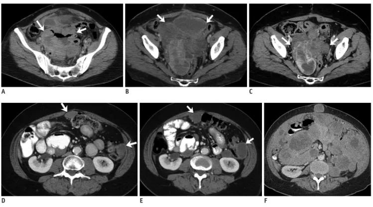 Fig. 2. 53-year-old woman with small bowel gastrointestinal stromal tumor with exon 9 mutation
