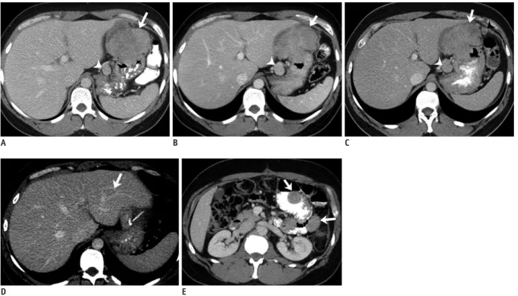 Fig. 3. 41-year-old man with gastric GIST with SDH mutation.