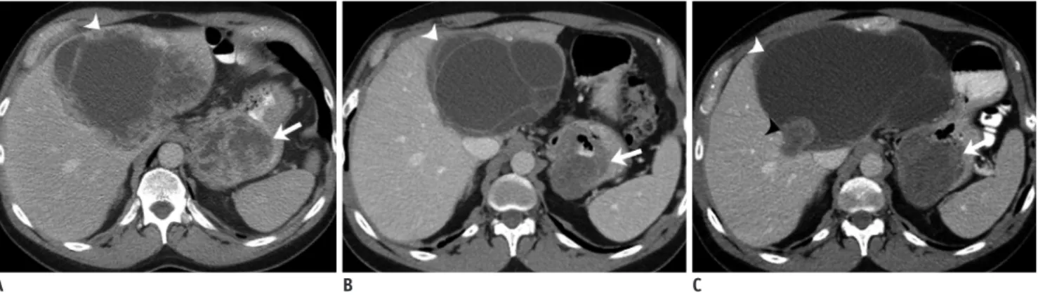 Fig. 5. 67-year-old man with gastric GIST metastatic to liver.