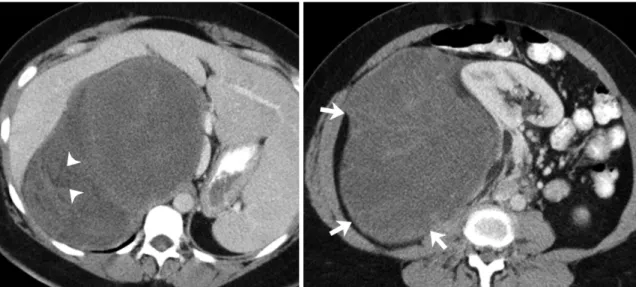Fig. 2. 61-year-old woman with well differentiated retroperitoneal liposarcoma. 