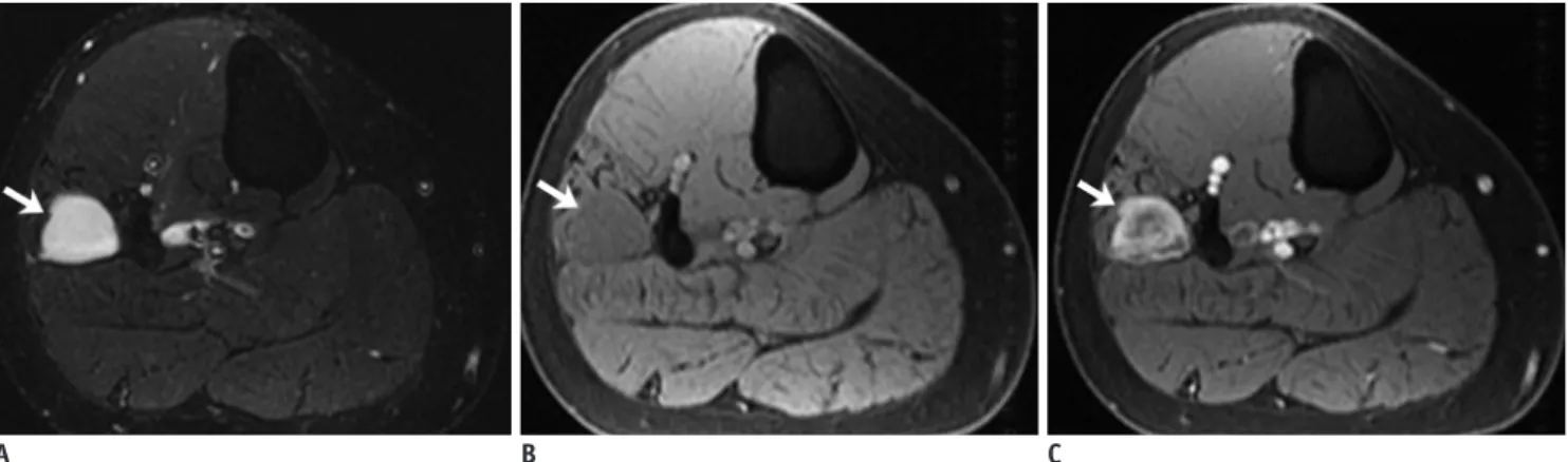 Fig. 4. 41-year-old man with myxoid liposarcoma. 
