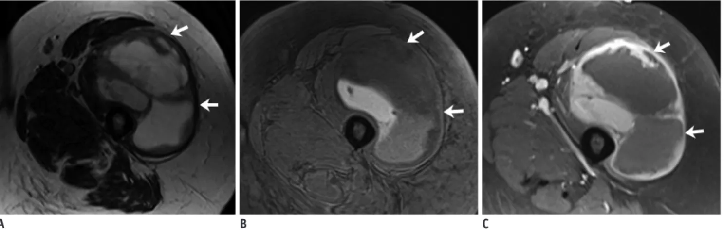 Fig. 7. 60-year-old woman with leiomyosarcoma of deep soft tissues of extremity. 