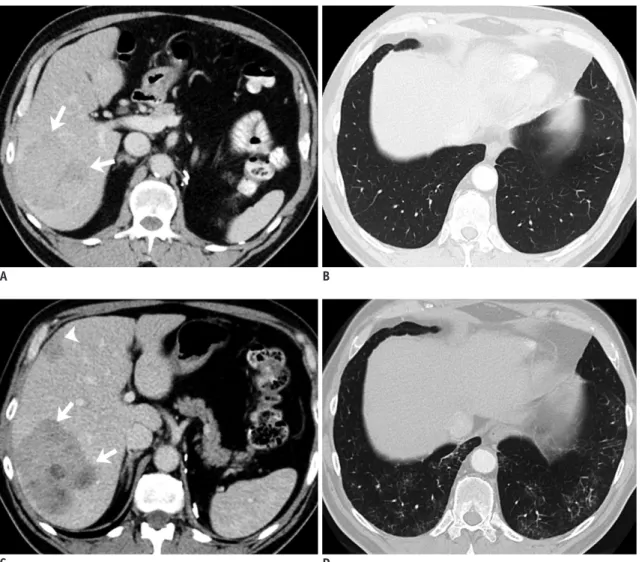 Fig. 10. 72-year-old man with metastatic malignant PEComa treated with mTOR inhibitor