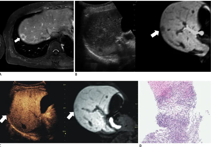Fig. 3. CEUS with fusion imaging-guided biopsy for suspected malignant hepatic lesion.