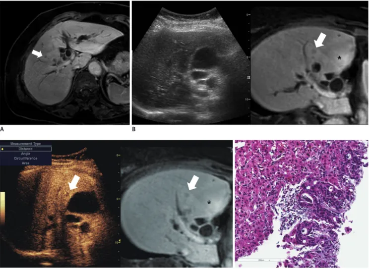 Fig. 4. CEUS and fusion imaging-guided biopsy for indeterminate focal hepatic lesion.