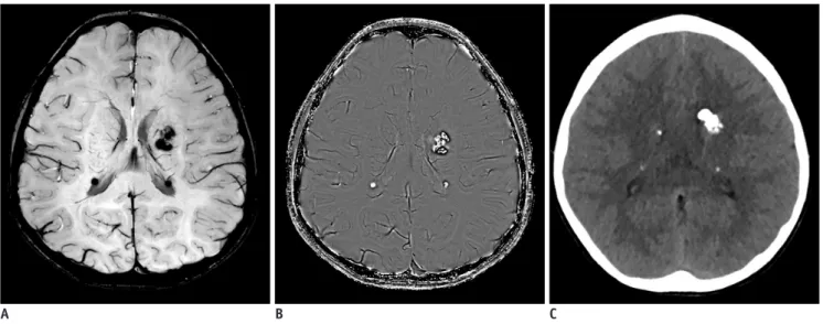 Fig. 8. 11-year-old boy with tuberous sclerosis. 