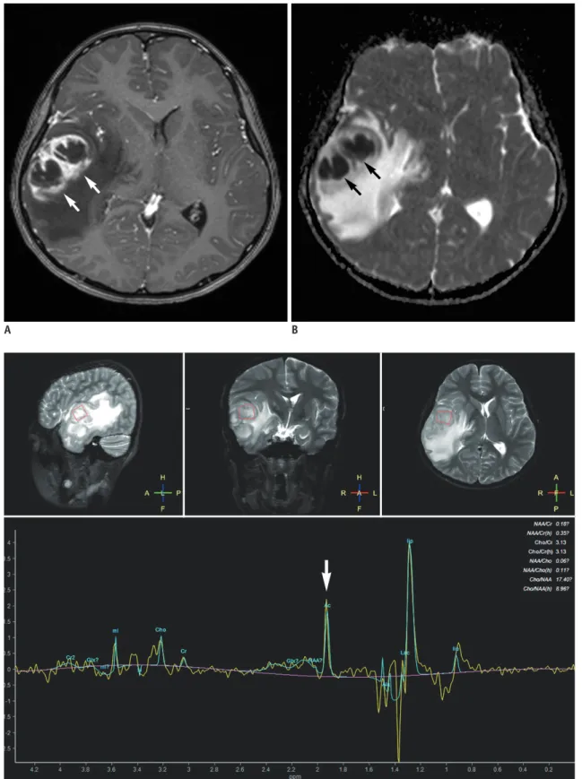 Fig. 2. 11-year-old boy with pyogenic abscess. 