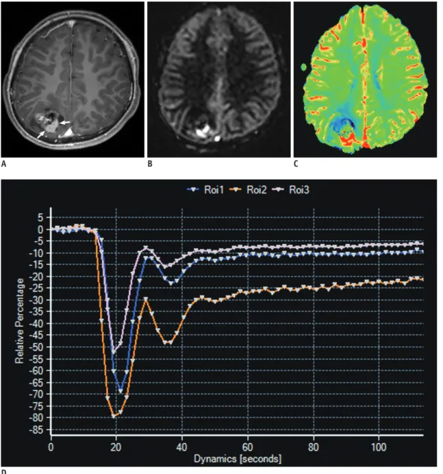 Fig. 6. 13-year-old boy with clear cell ependymoma (WHO grade II).