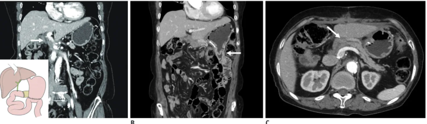 Fig. 1. Schema (lower left corner in A) and postoperative computed tomography coronal (A and B) and axial (C) images of  Whipple operation