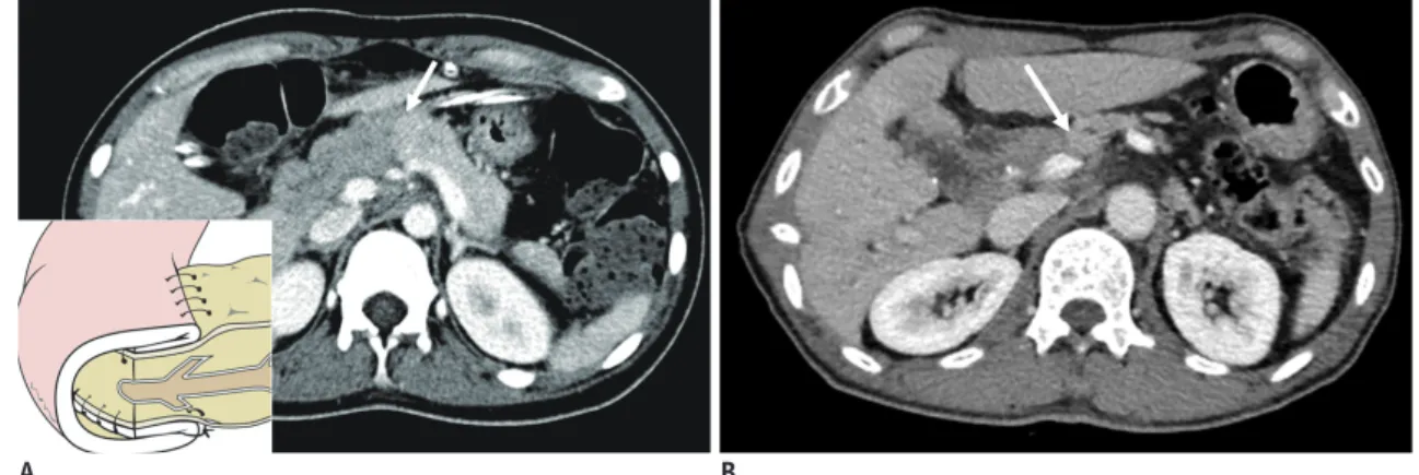 Fig. 3. Invagination pancreaticojejunostomy (dunking method) (schema: lower left corner in A)
