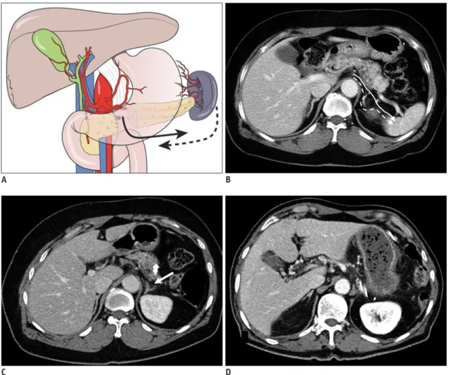 Fig. 6. Schema and postoperative computed tomography image of distal pancreatectomy.