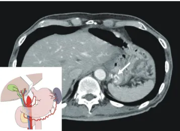 Fig. 8. Schema (lower left corner of A) and postoperative coronal (A) and axial (B) computed tomography images after central  pancreatectomy