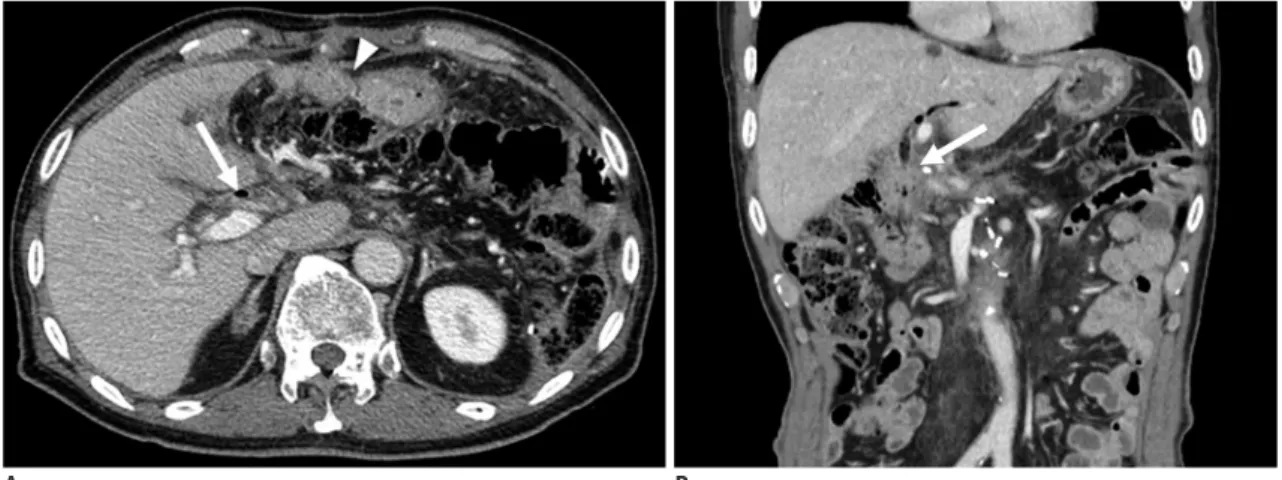 Fig. 9. Postoperative axial (A) and coronal (B) computed tomography image of total pancreatectomy
